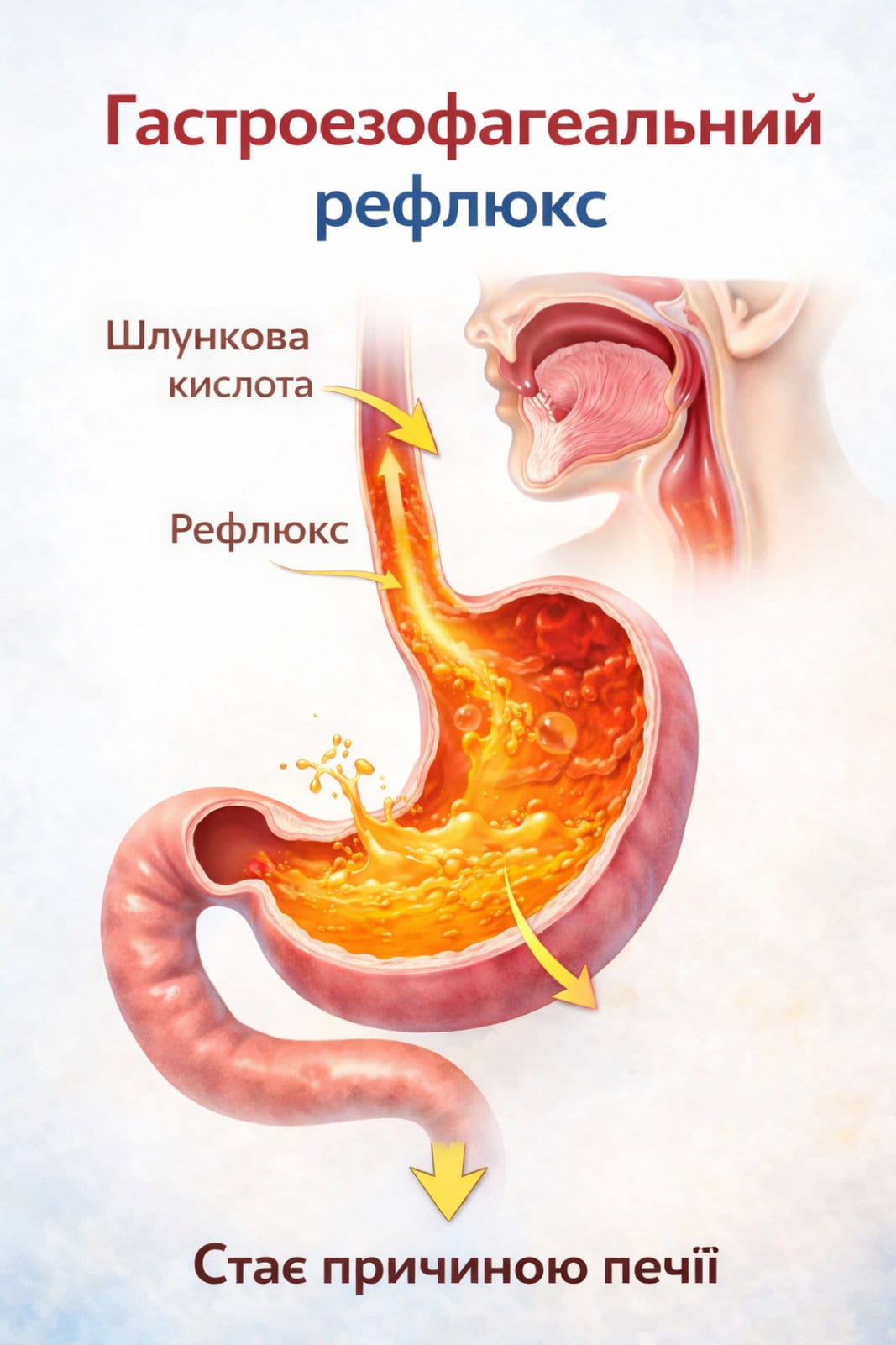 Гастроезофагеальний рефлюкс