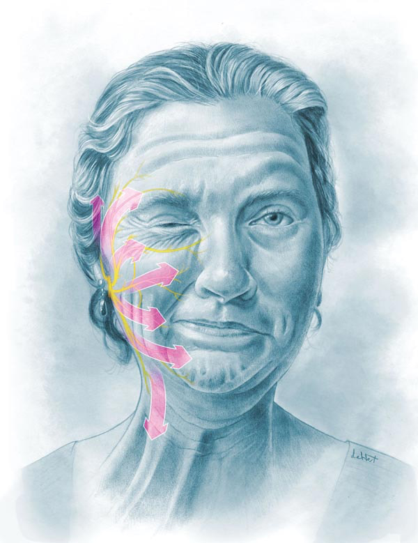 Геміфаціальний спазм